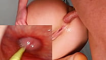 BEST ANAL. Camera in Her Ass Deep Anal Fuck and Internal Creampie